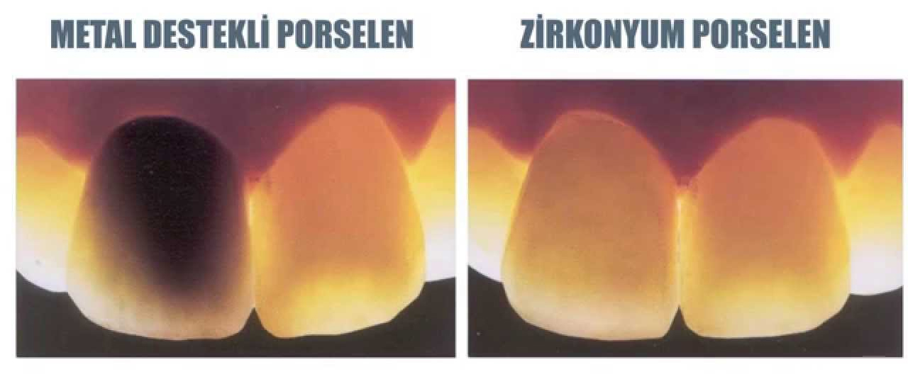 Zirkonyum Porselen Kaplama